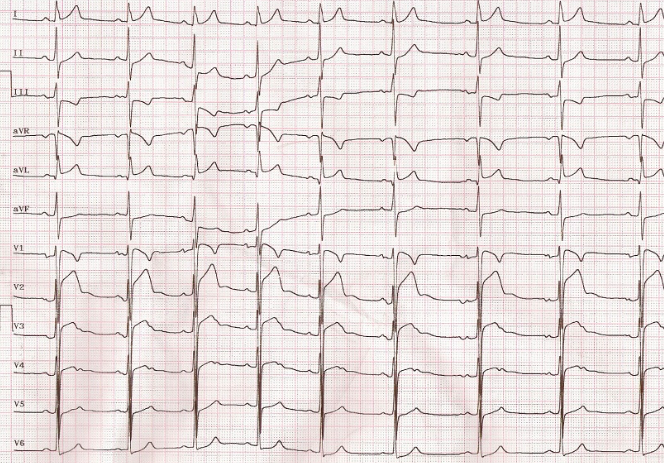 https://clinicahispanacorazonyvida.com/wp-content/uploads/2024/05/ECG-en-atletas-hallazgos-normales-y-anormales.png